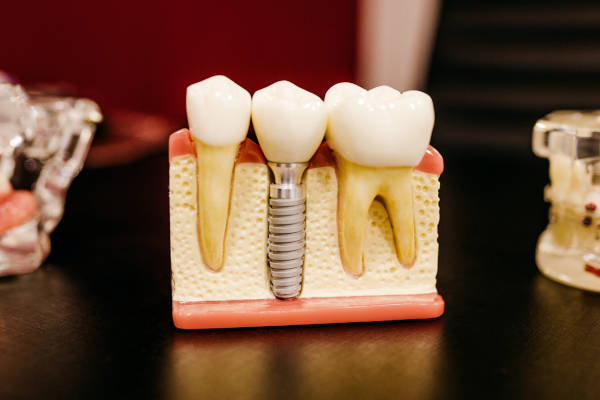 dental prosthesis