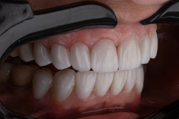 showing teeth